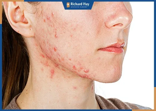Da kích ứng do sử dụng các loại mỹ phẩm nâng cơ sai cách
