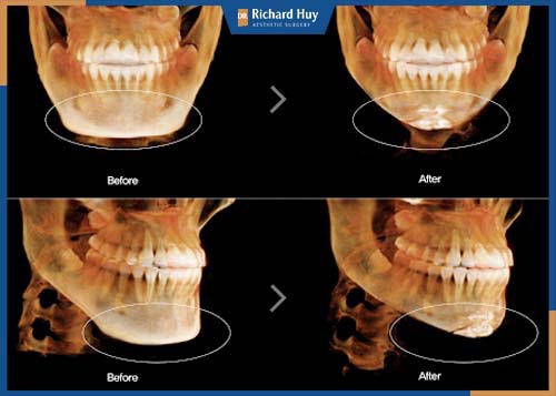 Hình ảnh chụp CT trước và sau phẫu thuật gọt mặt trái xoan 