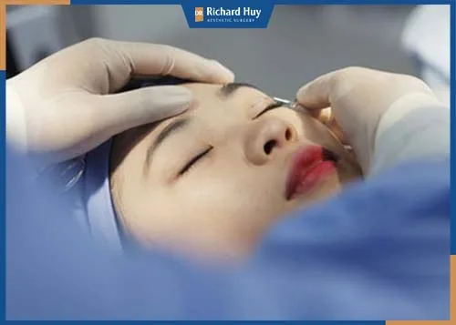 Nhấn mí mắt sử dụng dao kéo, tác động sâu vào mí mắt Nhấn mí mắt sử dụng dao kéo, tác động sâu vào mí mắt