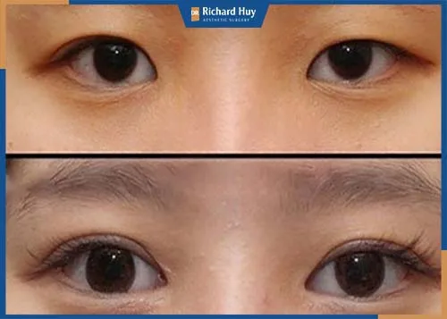Cơ nâng mi và sụn mí mắt không còn liên kết tốt sau một khoảng thời gian và có dấu hiệu lão hóa Cơ nâng mi và sụn mí mắt không còn liên kết tốt sau một khoảng thời gian và có dấu hiệu lão hóa