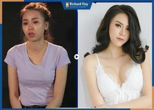 Nhanh chóng biến ngực ốc vít thành ngực tròn căng tràn sức sống 