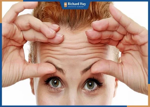 Nếp nhăn trên trán phụ nữ xuất hiện nhiều sau tuổi 35