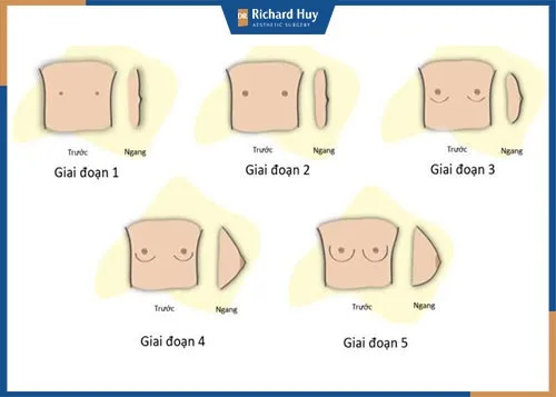 Tình trạng phát triển không đồng đều ở tuổi dậy thì của nữ