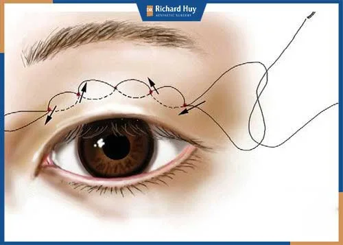 Nhấn mí bằng chỉ là phương pháp tạo mắt 2 mí hiệu quả, an toàn Nhấn mí bằng chỉ là phương pháp tạo mắt 2 mí hiệu quả, an toàn