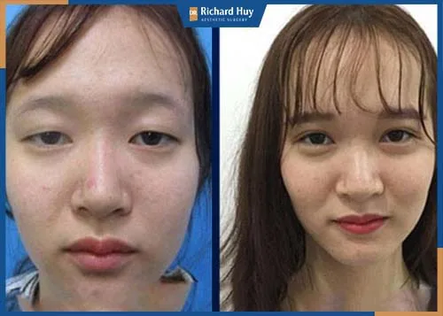 Thời gian để nếp mí mắt rõ ràng và đôi mắt to tự nhiên nhất trong khoảng từ 3 đến 5 năm. Thời gian để nếp mí mắt rõ ràng và đôi mắt to tự nhiên nhất trong khoảng từ 3 đến 5 năm.
