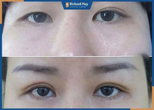 Sau khoảng thời gian 2 đến 3 năm sau phẫu thuật, tình trạng nếp gấp tạo hai mí không rõ ràng, Sau khoảng thời gian 2 đến 3 năm sau phẫu thuật, tình trạng nếp gấp tạo hai mí không rõ ràng,