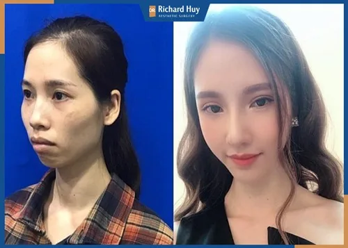 Nhan sắc trước và sau quá trình "lột xác" của Phan Thị May Nhan sắc trước và sau quá trình "lột xác" của Phan Thị May