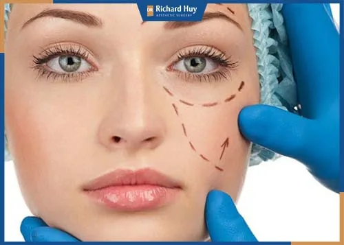 Mắt. khóe miệng, trán là những vùng dễ xuất hiện nếp nhăn Mắt. khóe miệng, trán là những vùng dễ xuất hiện nếp nhăn