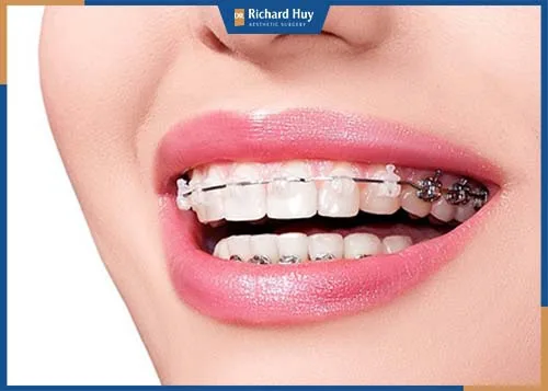 Niềng răng có thể cải thiện tình trạng cằm ngắn nhẹ Niềng răng có thể cải thiện tình trạng cằm ngắn nhẹ