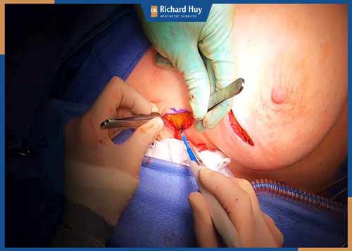 Phương pháp cắt bỏ vú toàn phần giúp hạn chế tối đa sự xâm lấn của tế bài ung thư