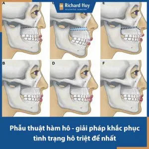 Phẫu thuật hàm hô giá bao nhiêu? Có nên chỉnh hình hàm hô giá rẻ hay không?