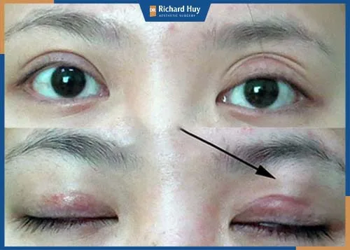 Mắt sau nhấn không đều, hài hòa với gương mặt. Tình trạng viêm mí mắt, sưng đỏ do chăm sóc hậu phẫu không đúng cách Mắt sau nhấn không đều, hài hòa với gương mặt. Tình trạng viêm mí mắt, sưng đỏ do chăm sóc hậu phẫu không đúng cách