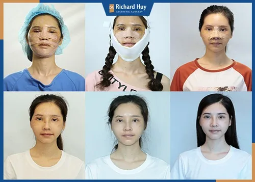 Quá trình hồi phục và kết quả bất ngờ về nhan sắc của Phan Thị May Quá trình hồi phục và kết quả bất ngờ về nhan sắc của Phan Thị May