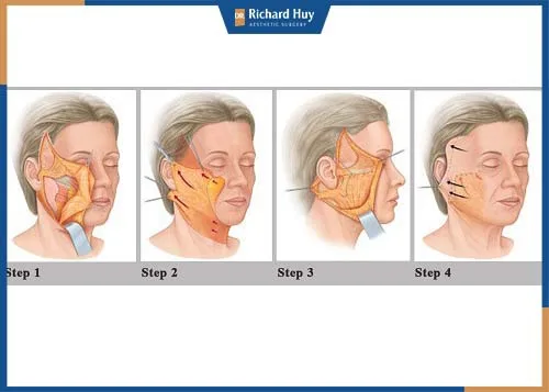 Mô phỏng kỹ thuật căng da nội soi mặt Mô phỏng kỹ thuật căng da nội soi mặt