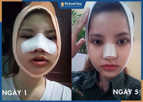 Khách hàng sau 5 ngày tình trạng gương mặt bớt sưng, giảm đau rõ rệt Khách hàng sau 5 ngày tình trạng gương mặt bớt sưng, giảm đau rõ rệt