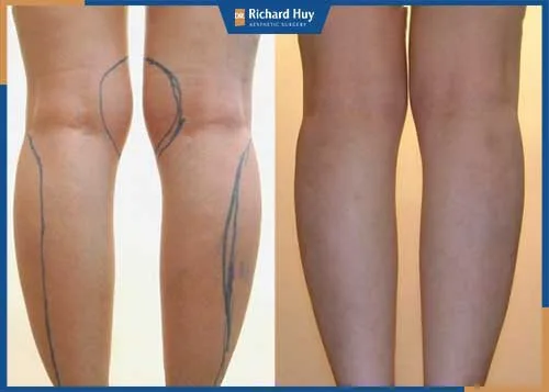 Hút mỡ bắp chân với hiệu quả giảm mỡ bất ngờ