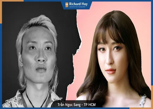 Nên độn thái dương lõm ở đâu?