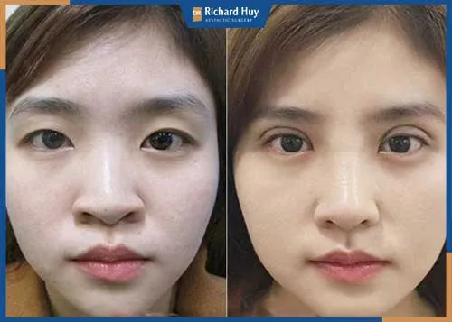 Nhấn mí Multin Point tạo nếp mí chắc chắn Nhấn mí Multin Point tạo nếp mí chắc chắn