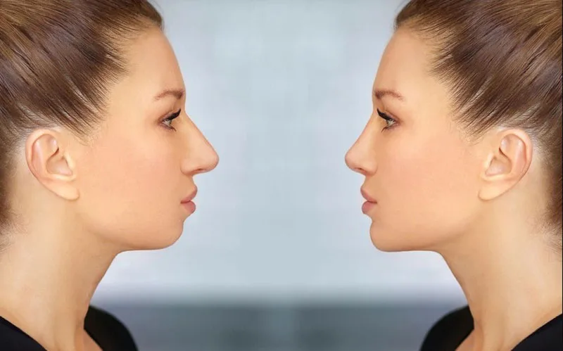 Khách hàng sở hữu dáng cằm Vline sau khi trượt cằm