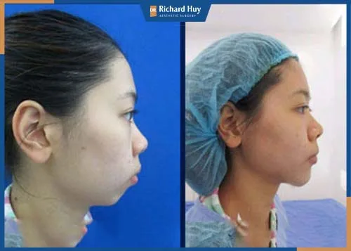 Dáng cằm lên Vline cân đối với gương mặt, không quá lộ liễu. Dáng cằm lên Vline cân đối với gương mặt, không quá lộ liễu.