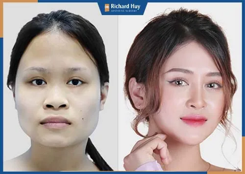 Cằm được đẩy ra ngoài hiệu quả, dáng cằm lên cân đối và tự nhiên Cằm được đẩy ra ngoài hiệu quả, dáng cằm lên cân đối và tự nhiên