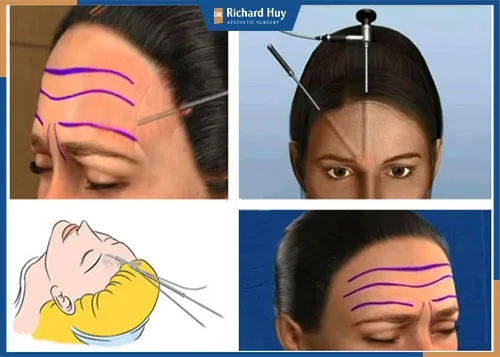Kỹ thuật căng da trán nội soi để loại bỏ nếp nhăn