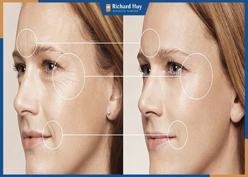 Có nên xóa nếp nhăn trên trán hay không?