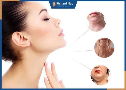 Xóa nếp nhăn vùng da cổ giúp gương mặt trẻ hóa, cải thiện đáng kể Xóa nếp nhăn vùng da cổ giúp gương mặt trẻ hóa, cải thiện đáng kể