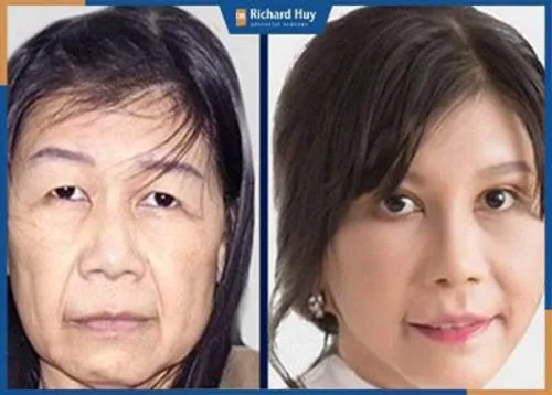 Loại bỏ nếp nhăn trên trán triệt để bằng công nghệ hiện đại