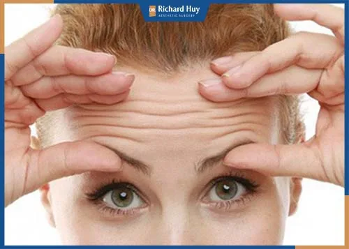Nhăn mặt, tâm trạng không tốt, cau có, stress khiến vết nhăn trán xuất hiện sớm hơn. Nhăn mặt, tâm trạng không tốt, cau có, stress khiến vết nhăn trán xuất hiện sớm hơn.