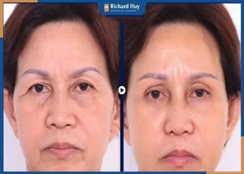 Khách hàng xóa nếp nhăn bằng công nghệ thẩm mỹ