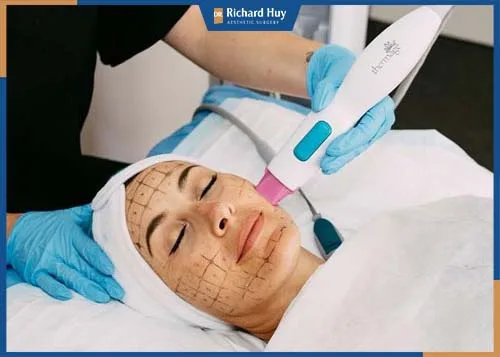 Kết hợp sóng siêu âm và sóng RF giúp nâng cơ chùng nhão, làm đầy nếp nhăn rãnh mũi má chùng xệ, thúc đẩy quá trình sản sinh collagen và elastin