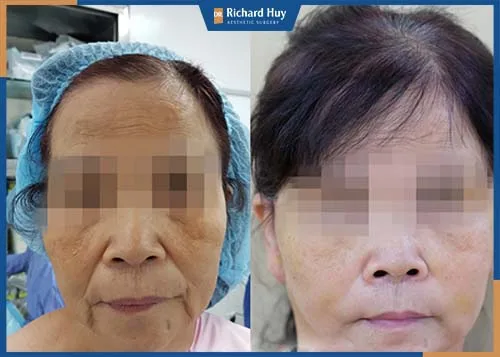 Biến chứng má chảy xệ khiến gương mặt già nua Biến chứng má chảy xệ khiến gương mặt già nua