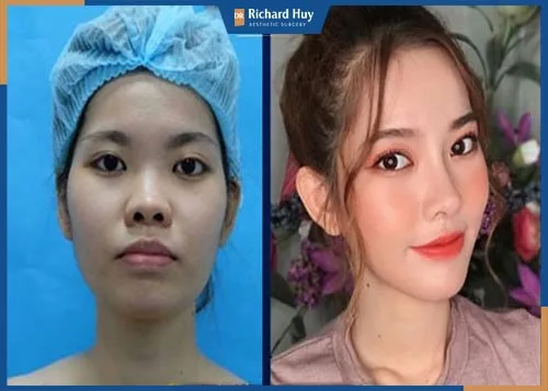 Các địa chỉ độn cằm ở Hà Nội