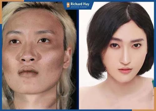 Gọt trán là phương pháp thay đổi dáng trán để cân đối với toàn bộ gương mặt Gọt trán là phương pháp thay đổi dáng trán để cân bằng với toàn bộ gương mặt