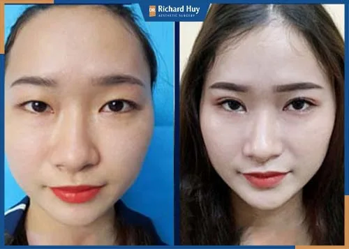 Hạ thấp vùng trán từ 5mm đến 2cm, khắc phục triệt để tình trạng trán cao, trán dô Hạ thấp vùng trán từ 5mm đến 2cm, khắc phục triệt để tình trạng trán cao, trán dô