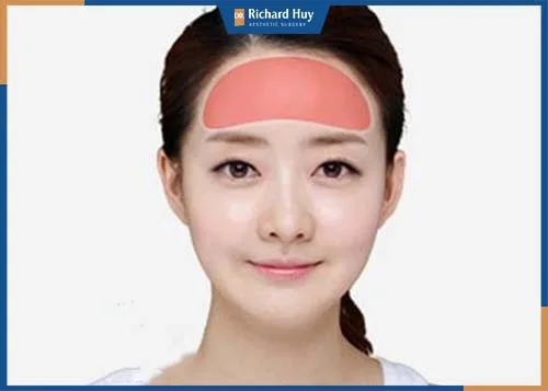 Phương pháp được thực hiện bằng cách đưa chất liệu để làm đầy vùng trán bị thấp, lõm không cân xứng với tỷ lệ gương mặt Phương pháp được thực hiện bằng cách đưa chất liệu để làm đầy vùng trán bị thấp, lõm không cân xứng với tỷ lệ gương mặt