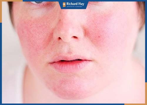 Triệu chứng mẩn đỏ ngứa ngáy sau tiêm Botox
