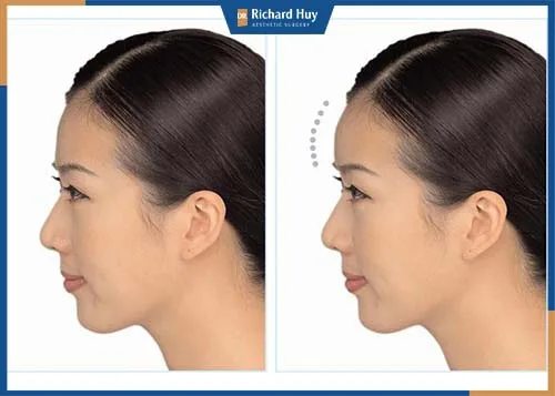 Phẫu thuật độn trán giúp khắc phục các nhược điểm của trán và tạo hình trái tim như mong muốn. Phẫu thuật độn trán giúp khắc phục các nhược điểm của trán và tạo hình trái tim như mong muốn.