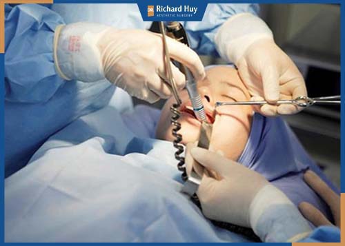 Kỹ thuật phẫu thuật hàm móm tác động trực tiếp vào xương, yêu cầu kỹ thuật bác sĩ cao 