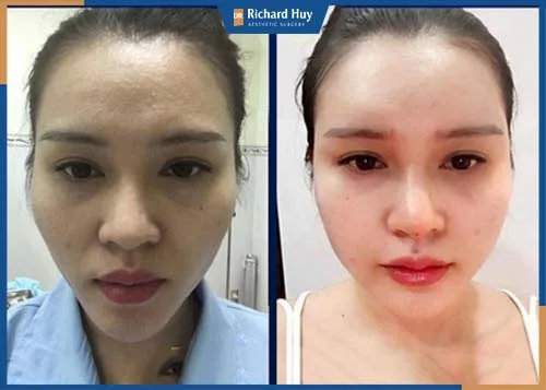 Cải thiện rõ rệt đường nét trên gương mặt, khắc phục triệt để tình trạng trán lõm, trán thấp. Cải thiện rõ rệt đường nét trên gương mặt, khắc phục triệt để tình trạng trán lõm, trán thấp.