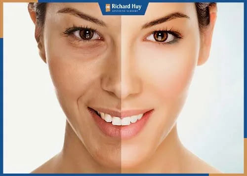 Gương mặt được trẻ hóa toàn diện, cơ mặt được thả lỏng, tăng khả năng đàn hồi trên da. Gương mặt được trẻ hóa toàn diện, cơ mặt được thả lỏng, tăng khả năng đàn hồi trên da.