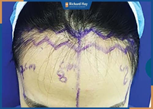 Vết rạch tại đường viền chân tóc theo được zíc zắc khó phát hiện dấu tích phẫu thuật 