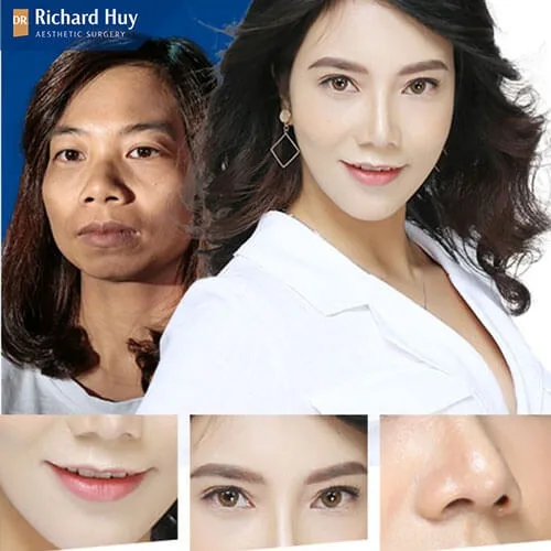 Hình ảnh khách hàng độn cằm không đau Hình ảnh khách hàng độn cằm không đau