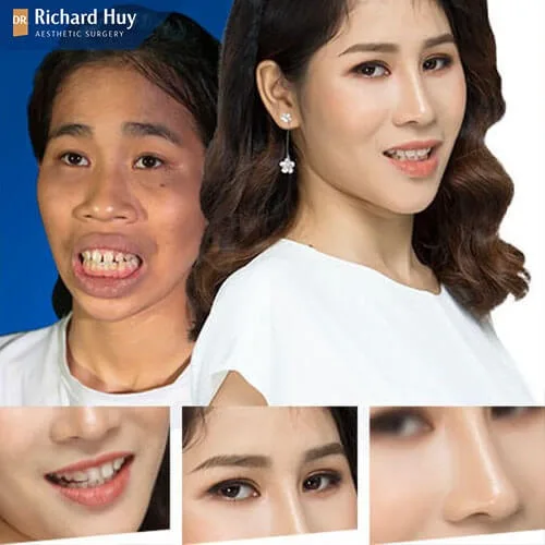 Ảnh khách hàng sau khi thực hiện độn cằm không đau Ảnh khách hàng sau khi thực hiện độn cằm không đau