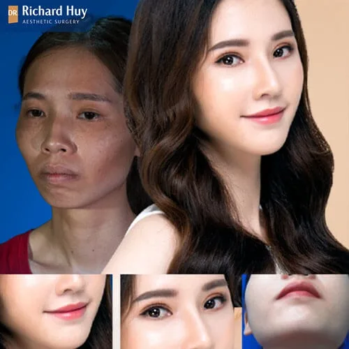 Hình ảnh trước sau của khách hàng độn cằm Hình ảnh trước sau của khách hàng độn cằm