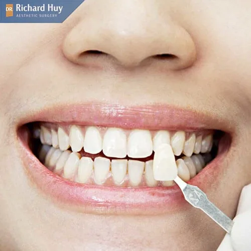 Bọc răng sứ giúp cải thiện móm miệng Bọc răng sứ giúp cải thiện móm miệng