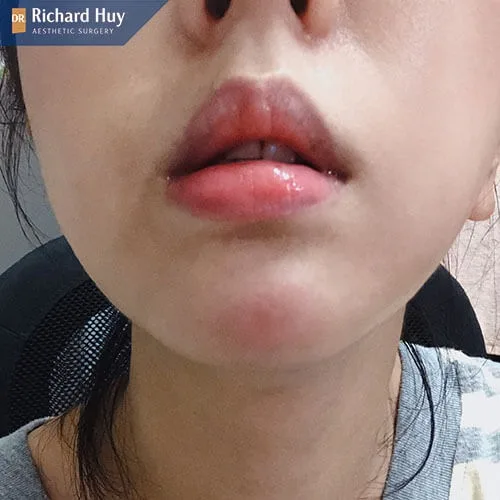 Cằm bị bầm tím, tụ máu Cằm bị bầm tím, tụ máu