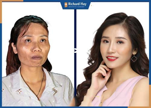Hình ảnh khách hàng thay đổi diện mạo gò má cao sau khi phẫu thuật tại Dr. Richard Huy 