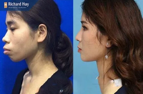 Khách hàng trước sau khi thực hiện phẫu thuật hàm hô